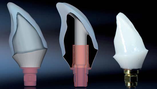 2_ Computer-aided design und fertig verklebtes, zweiteiliges CAD/CAM Zirkonabutment auf Titan-Klebebasis.