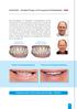 Implantate Invisalign-Therapie vor Versorgung mit Zahnimplantaten