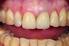 Extrusion von Zähnen als Alternative zur klassischen Augmentation