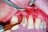 Piezochirurgie in der Zahnmedizin