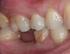 an die Stelle des fehlenden Zahnes/der fehlenden Zähne eingesetzt worden. Sie sollen nun nach der Einheilzeit mit einem Zahnersatz versorgt werden.