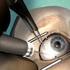 Behandlung des Makulaödems bei Uveitis durch operative Medikamenteneingabe in das Auge
