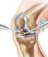 Arthroskopische Knieoperation. zur Meniskusbehandlung