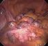 Diverticulosis of the colon Differential Diagnosis & Prognosis
