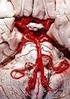 Pseudotumor cerebri. Anatomie: Das Gehirn und das Rückenmark schwimmen in einer klaren Flüssigkeit, die als Liquor cerebrospinalis bezeichnet wird.