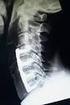 Operative Behandlung der Halswirbelsäule II. Langstreckige Eingriffe von hinten durch den Nacken