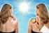 Früherkennung von Hautkrebs und Sonnenschutz