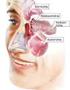 Komplikationen entzündlicher Nasennebenhöhlenerkrankungen: Klinik, therapeutischer Verlauf, Ergebnisse - Eine retrospektive Analyse -