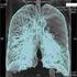 Lungenperfusionsszintigraphie