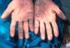5-Finger-Regel für akute Intoxikationen