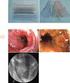 Rolle der intraoperativen Cholangiografie bei der laparoskopischen Cholezystektomie