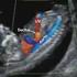 Dopplersonographie bei fetalen Herzfehlern