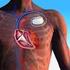 Leben mit dem implantierbaren Defibrillator