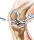 Verschleiß des Kniegelenks - welche Behandlung ist sinnvoll?