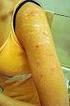 Dermatillomanie. Skin picking disorder