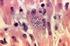 MRSA KISS: Surveillance Protokoll Methicillin Resistenter Staphylococcus aureus in Krankenhäusern