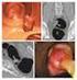 Magnetresonanzkolonographie zur Erkennung kolorektaler Neoplasien bei asymptomatischen Erwachsenen