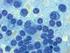 CD5 + B-Lymphozyten und Immunglobulin-Leichtketten bei HIV-Infizierten - Korrelation mit klinischen und immunologischen Parametern