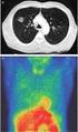 In general, all solitary pulmonary nodules should be considered malignant until proven otherwise. Tan et al., Chest 123 (2003)