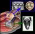 Herzklappe in Mitral- und Aortenposition