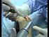 Hand Surgery HBS HEADLESS BONE SCREW SYSTEM
