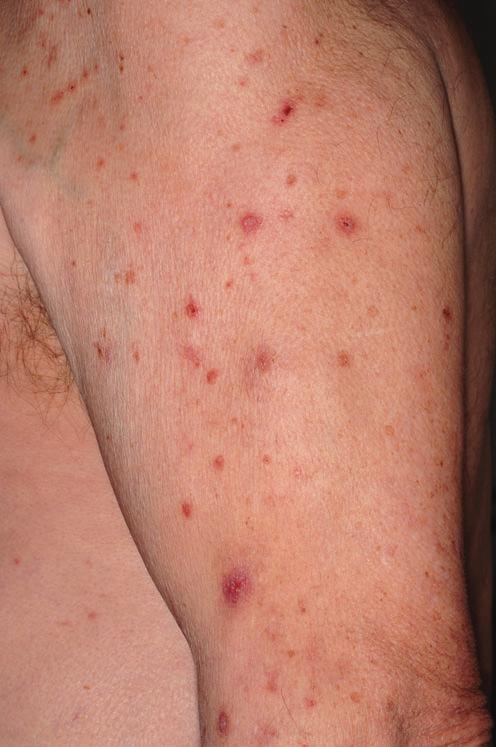 14 S. Ständer und Narben, das nur selten Primärläsionen aufweist. Lichenifizierte Läsionen, die häufig bei anderen juckenden Dermatosen zu sehen sind, entstehen nicht.