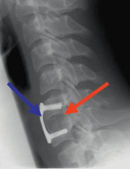 2: Stabilisierung der Halswirbelsäule mit Beckenkammspan (roter Pfeil) und Platte (blauer Pfeil) im seitlichen Röntgenbild.