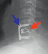 4: Stabilisierung der Halswirbelsäule mit metallischem Platzhalter (roter Pfeil) und Platte (blauer Pfeil) Abb. 5: Der neue Platzhalter mit integrierter Fixierung Abb.