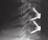 Durch die bis zu 4 mm dicken Platten, welche direkt unterhalb der Speiseröhre platziert werden mussten, gaben eine Reihe von Patienten zum Teil chronische Schluckbeschwerden nach diesem Eingriff an.