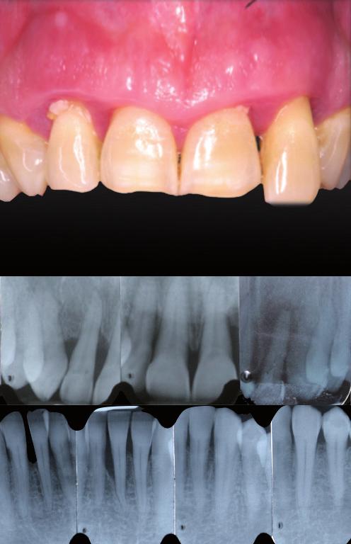 Sondierungstiefen, vertikalen Defekten, Furkationsbeteiligung, Zahnhypermobilität, Wanderungen und/ oder Auffächerungen von Zähnen, Zahnverlust, Alveolarkammdefekten und Verlust der Kaufunktion.