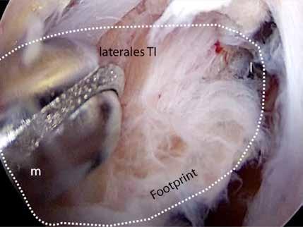 Schutz des NI. Abb. 5 Arthroskopie-Bild mit Beginn des Debridements mittels Shaver.