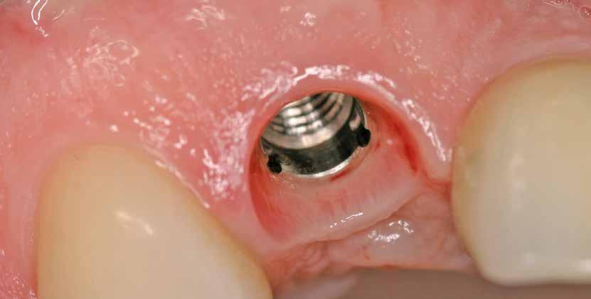 IMPLANTOLOGIE Die Socket Shield Technik Die Socket Shield Technik beschreibt ein chirurgisches Verfahren, bei dem bei einem zu extrahierenden Zahn die Wurzel nicht komplett entfernt wird, sondern ein