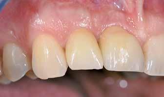nicht endodontisch behandelten Zähnen an, was aber von anderen Operateuren anders gehandhabt wird.