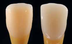 33 Einfluss der Stumpffarbe/Restzahnhartsubstanzfarbe Eine Zahnfarbenbestimmung an Zähnen, z.b. nach Kofferdammapplikation, führt zur Bestimmung einer helleren Zahnfarbe und damit ggf.