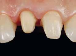 Zahn 11 zeigte nach einer endodontischen Behandlung eine Graufärbung und mehrere grossflächige, insuffiziente Composite-Füllungen (Abb. 20).