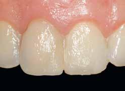 Zahn 21 besass eine leicht retrusive Zahnstellung, was durch die Labialkippung des Zahnes 22 optisch verstärkt wurde.