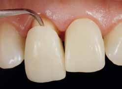 max Press HT hergestellte Veneer an Zahn 21 wurde mit Variolink Esthetic LC befestigt. Um die Graufärbung des Stumpfes an Zahn 11 abzudecken, wurde ein opakeres Material (IPS e.