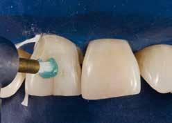 36 Ausgangssituation: Zahn 11 mit retrusiver Stellung und Schmelzriss auf der Vestibulärfläche Abb.