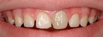 Das Schicksal solcher Zähne können Misserfolge nach primären endodontischen Behandlungen sein.