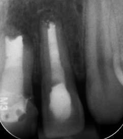 so lang wie möglich zu erhalten, da die Option auf eine Implantation bei Zahnverlust erst im Erwachsenenalter gegeben ist.