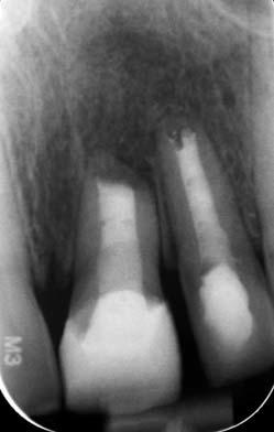 Abtragung des überschüssigen Materials mittels apikalen Zugangs am Zahn 21 mit zusätzlichem