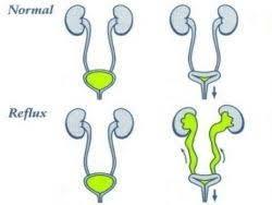 Definition vesicoureteraler Reflux (VUR) Rückfluss von Urin aus der Blase in Ureter und Niere Prävalenz 1-2% 10% aller pränatal diagnostizierten Uropathien NG-Alter Jungen