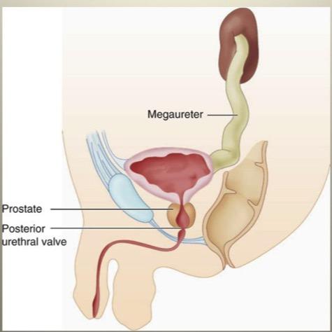Posteriore Urethralklappen = segelartige Einengung im Bereich der hinteren Harnröhre Ca.