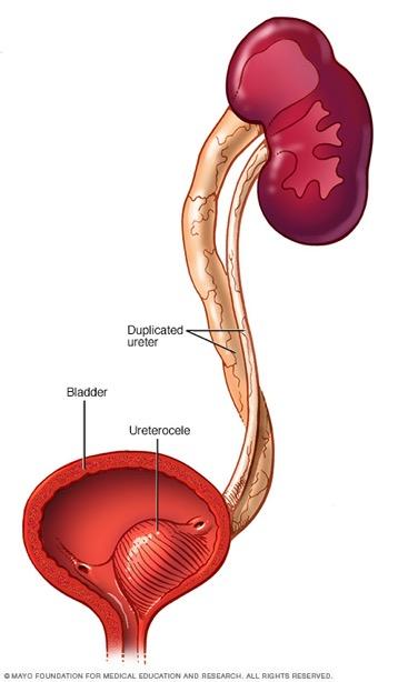 Ureterocele Vorwölbung/Aufblähung des distalen Harnleiters in die