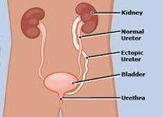 Ureterektopie Definition: Mündung des Harnleiters ausserhalb des Trigonums bzw.