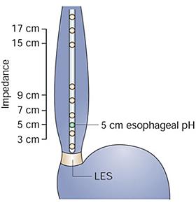 Impedanz ph-metrie Durchführung Ambulante 24h Messung von ph und Impedanz im Oesophagus mittels nasal eingelegter Sonde.