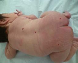 Geburt (idr innerhalb der ersten 4 Lebenswochen) - viel häufiger als kongenitale Hämangiome Hämangiomatose - Vorliegen > 10