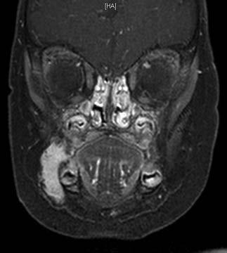Anteilen MRI: bei Hämangiomen an