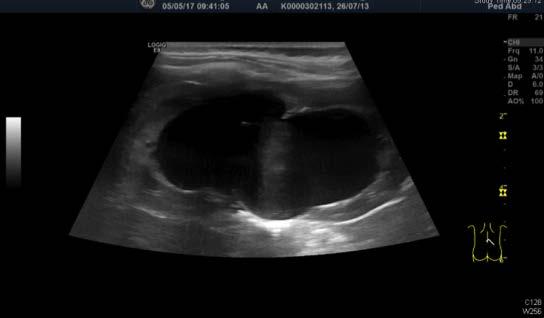 Postnatale Diagnostik - Ultraschall (je nach Schweregrad der Hydronephrose am 1. oder 4. Lebenstag) bzw.