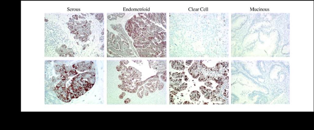 HE4 - Humanes Epididymis Protein-4 Neuer Tumormarker für das Ovarialkarzinom Bei allen serösen und endometroiden Subtypen auf zellulärer Ebene stark amplifiziert; Überexpression in 93% der serösen